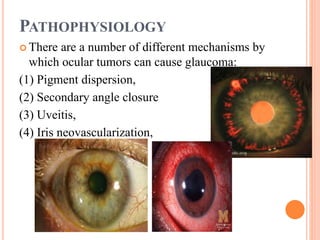 PATHOPHYSIOLOGY
 There are a number of different mechanisms by
which ocular tumors can cause glaucoma:
(1) Pigment dispersion,
(2) Secondary angle closure
(3) Uveitis,
(4) Iris neovascularization,
 