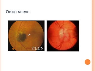 OPTIC NERVE
 