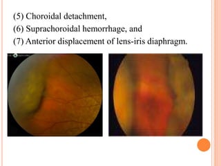 (5) Choroidal detachment,
(6) Suprachoroidal hemorrhage, and
(7) Anterior displacement of lens-iris diaphragm.
 