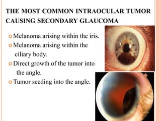 THE MOST COMMON INTRAOCULAR TUMOR
CAUSING SECONDARY GLAUCOMA
 Melanoma arising within the iris.
 Melanoma arising within the
ciliary body.
 Direct growth of the tumor into
the angle.
 Tumor seeding into the angle.
 