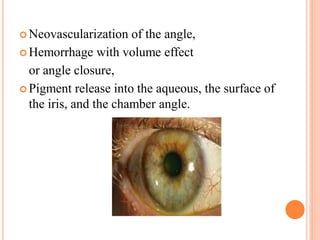  Neovascularization of the angle,
 Hemorrhage with volume effect
or angle closure,
 Pigment release into the aqueous, the surface of
the iris, and the chamber angle.
 