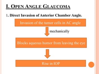 I. OPEN ANGLE GLAUCOMA
1. Direct Invasion of Anterior Chamber Angle.
mechanically
Invasion of the tumor cells in AC angle
Blocks aqueous humor from leaving the eye
Rise in IOP
 