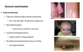 General examination
 External Adnexae
• Tuberous Sclerosis (Bourneville Syndrome)
• the “ash-leaf sign” & adenoma sebaceum
• Neurofibromatosis
– Subcutaneous plexiform neuromas
• Juvenile Xanthogranuloma,
• yellow and/or orange papules
• Oculodermal melanocytosis (nevus of Ota).
• skin pigmentation
14
 