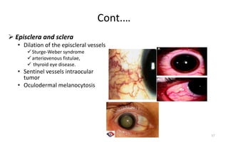 Cont.…
 Episclera and sclera
• Dilation of the episcleral vessels
Sturge-Weber syndrome
arteriovenous fistulae,
 thyroid eye disease.
• Sentinel vessels intraocular
tumor
• Oculodermal melanocytosis
17
 