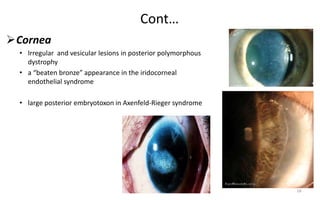 Cont…
Cornea
• Irregular and vesicular lesions in posterior polymorphous
dystrophy
• a “beaten bronze” appearance in the iridocorneal
endothelial syndrome
• large posterior embryotoxon in Axenfeld-Rieger syndrome
18
 