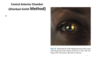 Central Anterior Chamber
(Ghorbani-Smith Method)
•
21
 
