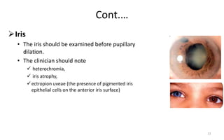 Cont.…
Iris
• The iris should be examined before pupillary
dilation.
• The clinician should note
 heterochromia,
 iris atrophy,
ectropion uveae (the presence of pigmented iris
epithelial cells on the anterior iris surface)
22
 