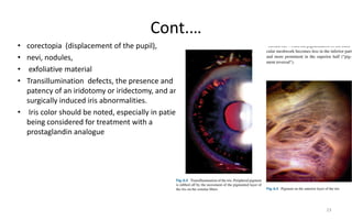 Cont.…
• corectopia (displacement of the pupil),
• nevi, nodules,
• exfoliative material
• Transillumination defects, the presence and
patency of an iridotomy or iridectomy, and any
surgically induced iris abnormalities.
• Iris color should be noted, especially in patients
being considered for treatment with a
prostaglandin analogue
23
 
