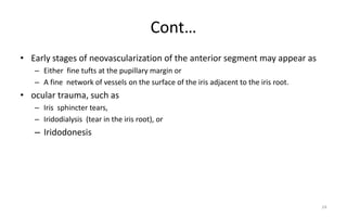Cont…
• Early stages of neovascularization of the anterior segment may appear as
– Either fine tufts at the pupillary margin or
– A fine network of vessels on the surface of the iris adjacent to the iris root.
• ocular trauma, such as
– Iris sphincter tears,
– Iridodialysis (tear in the iris root), or
– Iridodonesis
24
 