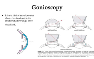 Gonioscopy
• It is the clinical technique that
allows the structures in the
anterior chamber angle to be
visualized.
28
 