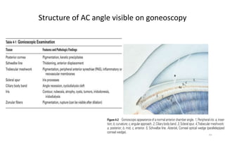 Structure of AC angle visible on goneoscopy
35
 