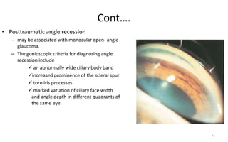Cont….
43
• Posttraumatic angle recession
– may be associated with monocular open- angle
glaucoma.
– The gonioscopic criteria for diagnosing angle
recession include
 an abnormally wide ciliary body band
increased prominence of the scleral spur
 torn iris processes
 marked variation of ciliary face width
and angle depth in different quadrants of
the same eye
 