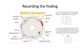 Recording the finding
44
 