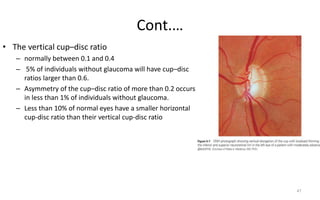 Cont.…
• The vertical cup–disc ratio
– normally between 0.1 and 0.4
– 5% of individuals without glaucoma will have cup–disc
ratios larger than 0.6.
– Asymmetry of the cup–disc ratio of more than 0.2 occurs
in less than 1% of individuals without glaucoma.
– Less than 10% of normal eyes have a smaller horizontal
cup-disc ratio than their vertical cup-disc ratio
47
 