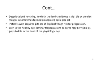Cont….
• Deep localized notching, in which the lamina cribrosa is vis i ble at the disc
margin, is sometimes termed an acquired optic disc pit
• Patients with acquired pits are at especially high risk for progression.
• Even in the healthy eye, laminar trabeculations or pores may be visible as
grayish dots in the base of the physiologic cup
50
 
