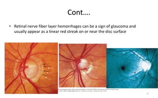 Cont….
• Retinal nerve fiber layer hemorrhages can be a sign of glaucoma and
usually appear as a linear red streak on or near the disc surface
51
 