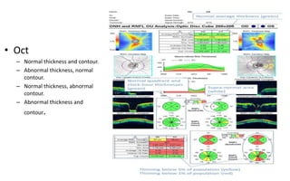 • Oct
– Normal thickness and contour.
– Abnormal thickness, normal
contour.
– Normal thickness, abnormal
contour.
– Abnormal thickness and
contour.
58
 