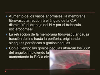 Aumento de los vasos anormales, la membrana fibrovascular recubrirá el ángulo de la C.A, disminuirá el drenaje del H.A por el trabeculo esclerocorneal.La retracción de la membrana fibrovascular causa tracción del iris hasta la periferia, originando sinequias periféricas o goniosinequias.Con el tiempo las goniosinequias abarcan los 360* del angulo, impidiendo la salida de H.A y aumentando la PIO a niveles muy elevados.