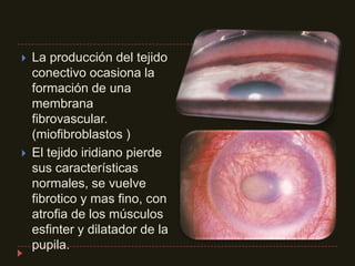 La producción del tejido conectivo ocasiona la formación de una membrana fibrovascular. (miofibroblastos )El tejido iridiano pierde sus características normales, se vuelve fibrotico y mas fino, con atrofia de los músculos esfinter y dilatador de la pupila.