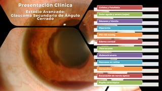 Cefalea y Fotofobia
Dolor agudo y severo (cejas)
Náuseas y Vómito
Hiperemia
PIO >60 mmHg
Edema corneal
Flare acuoso
Rubeosis severa
Neovasos en retina
Hemovítreo
Excavación de nervio óptico
Pupila corectópica
Presentación Clínica
Estadio Avanzado:
Glaucoma Secundario de Ángulo
Cerrado
 