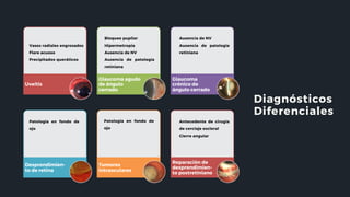 Diagnósticos
Diferenciales
Uveítis
Glaucoma agudo
de ángulo
cerrado
Glaucoma
crónico de
ángulo cerrado
Desprendimien-
to de retina
Tumores
intraoculares
Reparación de
desprendimien-
to postretiniano
Vasos radiales engrosados
Flare acuoso
Precipitados queráticos
Bloqueo pupilar
Hipermetropía
Ausencia de NV
Ausencia de patología
retiniana
Ausencia de NV
Ausencia de patología
retiniana
Patología en fondo de
ojo
Patología en fondo de
ojo
Antecedente de cirugía
de cerclaje escleral
Cierre angular
 