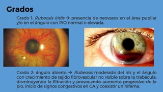 Grados
 Grado 1: Rubeosis iridis  presencia de neovasos en el área pupilar
y/o en el ángulo con PIO normal o elevada.
 Grado 2: ángulo abierto  Rubeosis moderada del iris y el ángulo
con crecimiento de tejido fibrovascular no visible sobre la trabécula,
disminuyendo la filtración y provocando aumento progresivo de la
pio, inicio de signos congestivos en CA y coexistir un hifema.
 