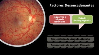 Factores Desencadenantes
Isquemia o
Hipoxia
Retiniana
Estado
Proangiogénico
 