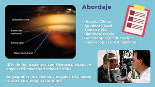 • Historia Clínica
• Agudeza Visual
• Toma de PIO
• Biomiscroscopía
• Gonioscopía (sin dilatación
• Fundoscopía (con dilatación)
Abordaje
10% de los pacientes con Neovascularización
angular NO muestran rubeosis iridis
Angiografías (Iris, Retina y Ángulo), USG modo
B, UBM, ERG, Doppler carotídeo
 