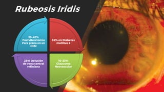 Rubeosis Iridis
33% en Diabetes
mellitus 2
10-23%
Glaucoma
Neovascular
28% Oclusión
de vena central
retiniana
25-42%
Postvitrectomía
Pars plana en en
DM2
 