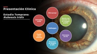 Presentación Clínica
Estadio Temprano:
Rubeosis iridis
Hallazgos
PIO normal
Mecho-nes
vascula-res
en margen
pupilar
Neovasos
en Iris
Neovasos
en Ángulo
6-10%
Pupila
poco
reactiva
Ectropión
uveal
 