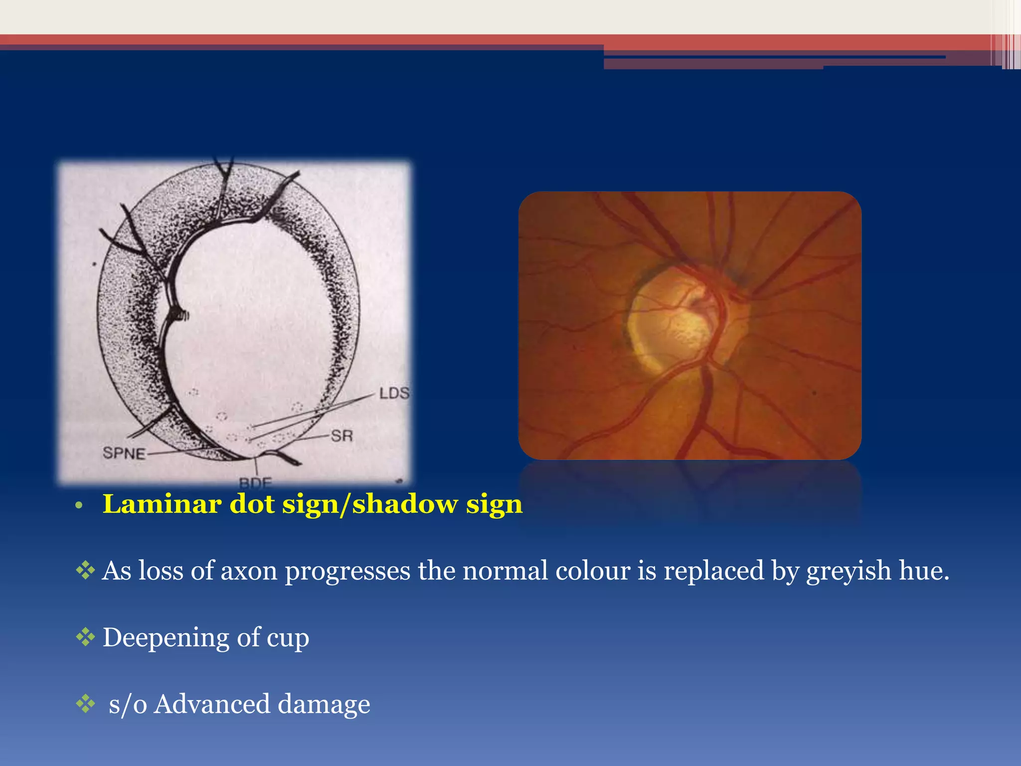 • Laminar dot sign/shadow sign
 As loss of axon progresses the normal colour is replaced by greyish hue.
 Deepening of cup
 s/o Advanced damage
 