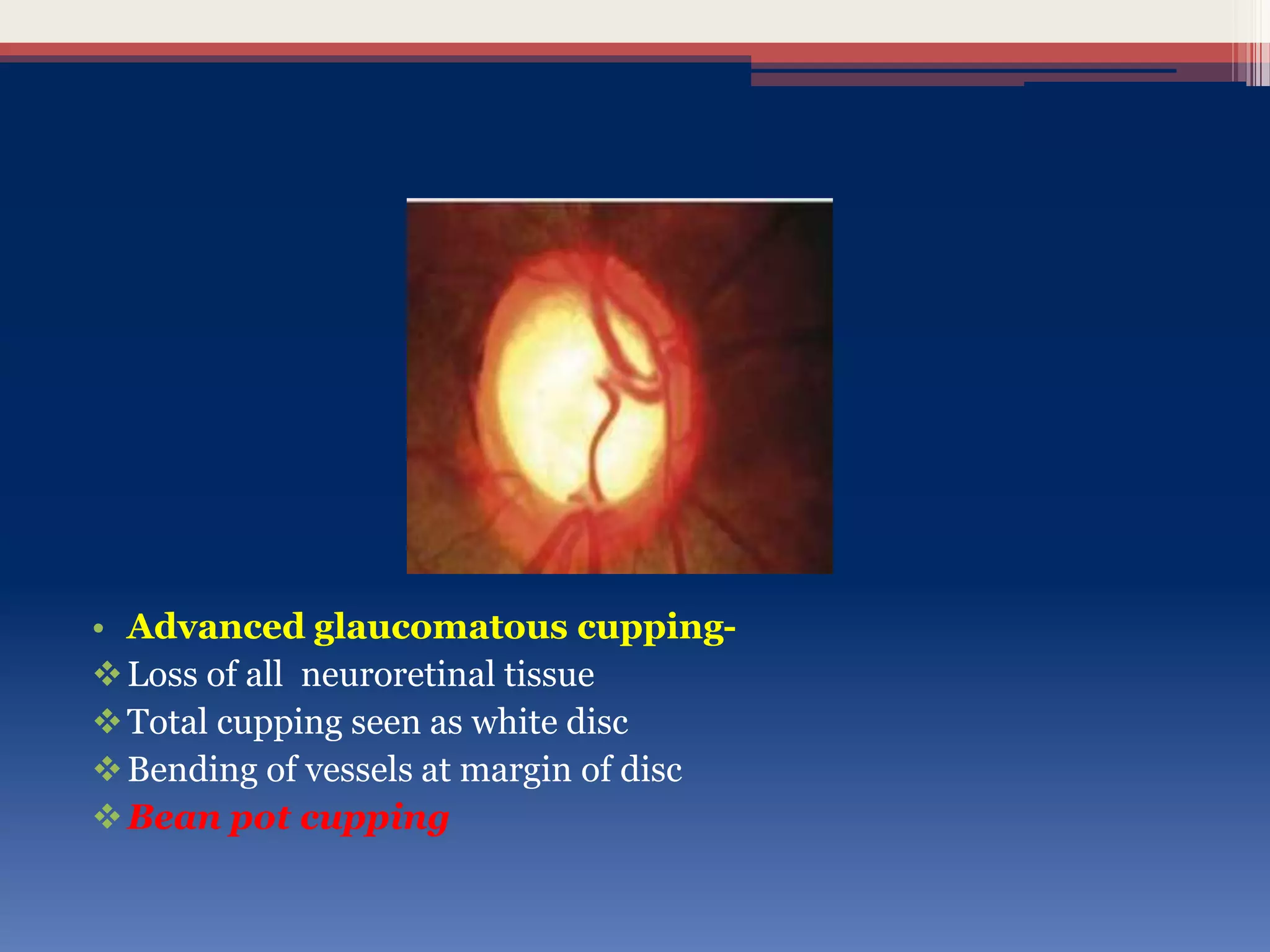 • Advanced glaucomatous cupping-
Loss of all neuroretinal tissue
Total cupping seen as white disc
Bending of vessels at margin of disc
Bean pot cupping
 