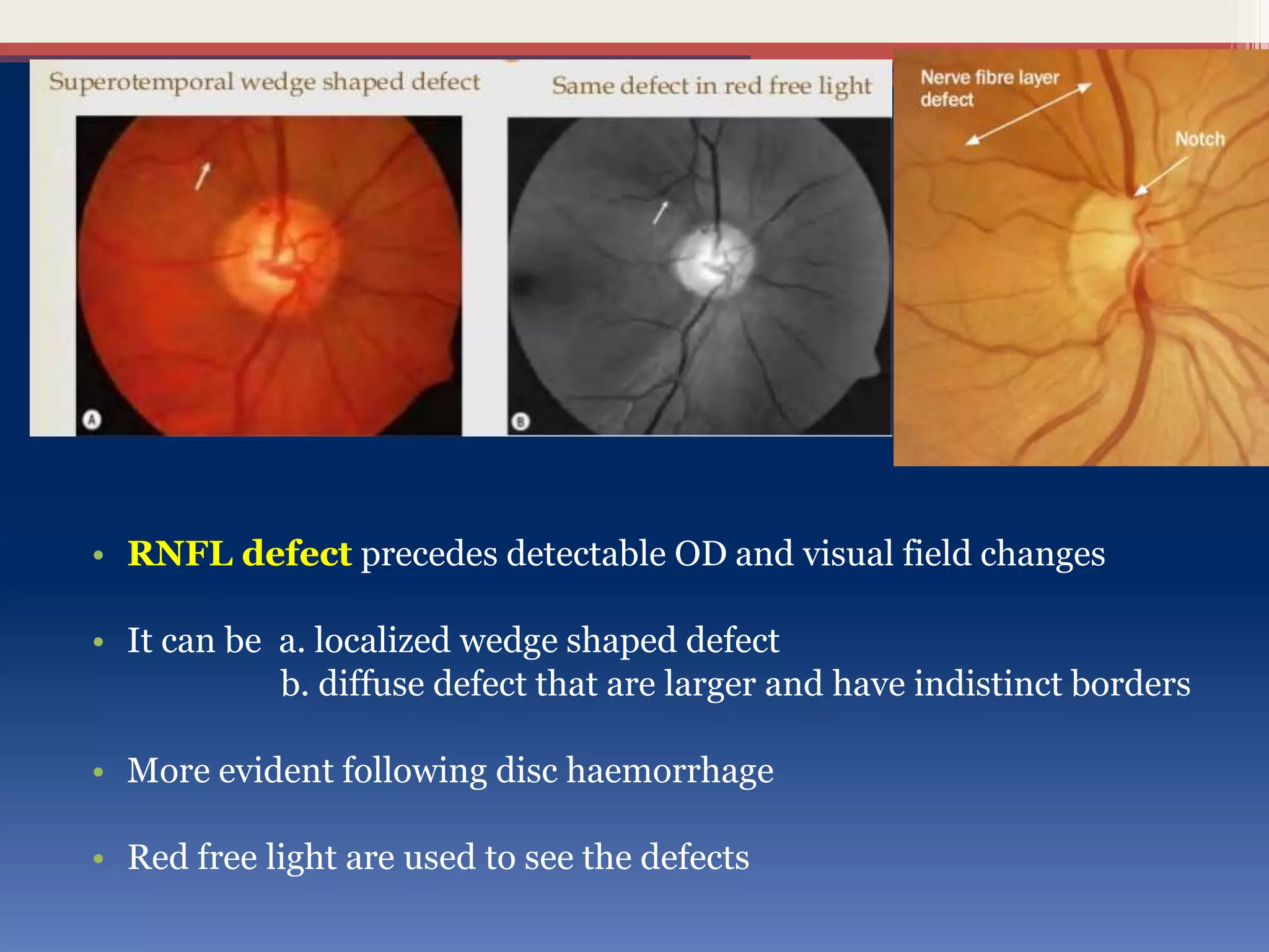 • RNFL defect precedes detectable OD and visual field changes
• It can be a. localized wedge shaped defect
b. diffuse defect that are larger and have indistinct borders
• More evident following disc haemorrhage
• Red free light are used to see the defects
 