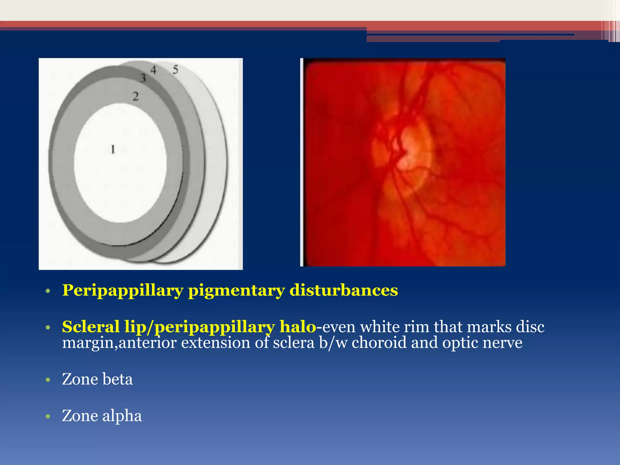 • Peripappillary pigmentary disturbances
• Scleral lip/peripappillary halo-even white rim that marks disc
margin,anterior extension of sclera b/w choroid and optic nerve
• Zone beta
• Zone alpha
 