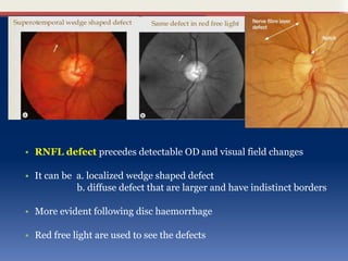 Glaucoma optic disc changes | PPTX