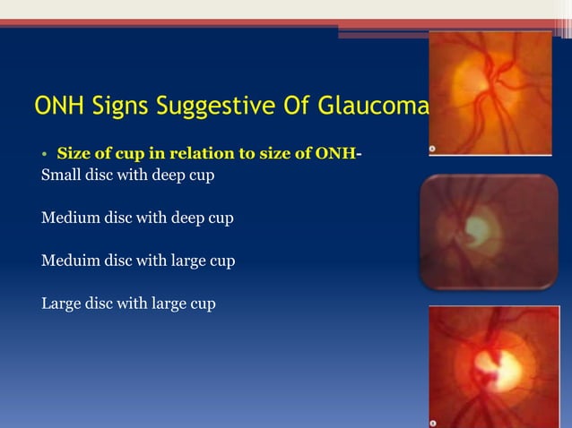 Glaucoma optic disc changes | PPTX | Eye and Vision Conditions ...