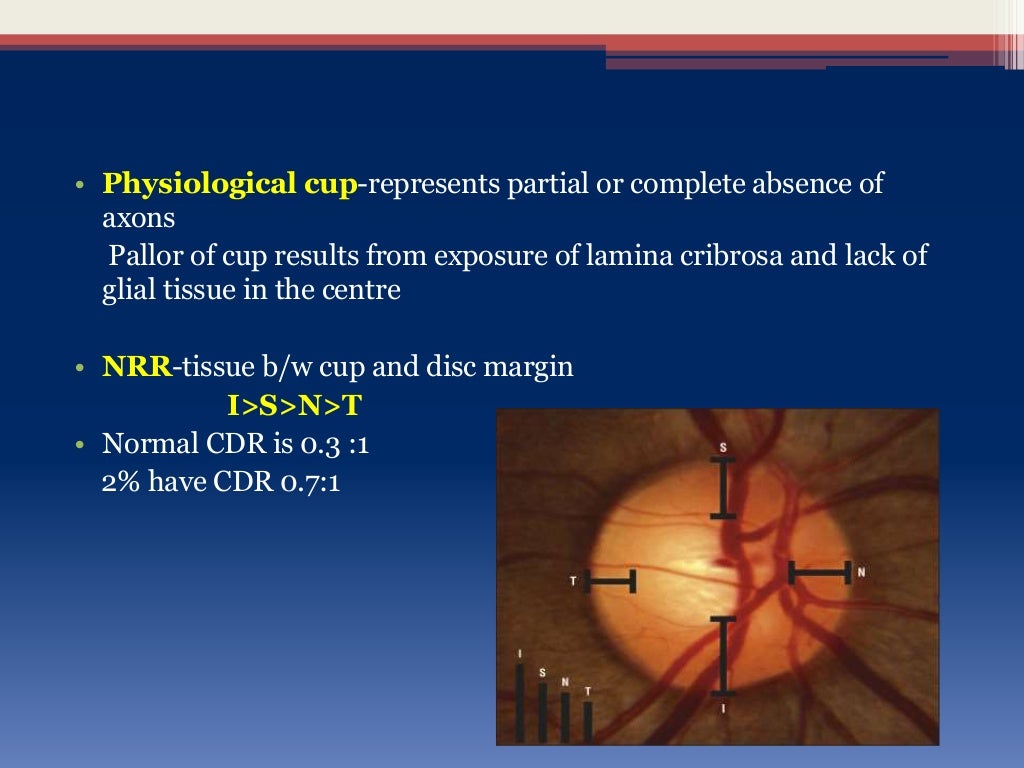 optic disc changes