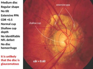 Disc At Risk Glaucoma Optic Neuropathy Evaluation - www.gone-project.com EXAMPLES ...