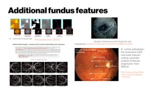 Additionalfundusfeatures
Annunziata et al. (2015)
In certain pathologies,
the treatmeant itself
may leave features
making automatic
analysis of disease
progression more
difficult
http://www.coatswortheye
clinic.co.uk/photography
/3102576
Vascular enhancement with fluorescein dye
(angiography, emedicine.medscape.com/article/1223882-workup)
 
