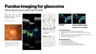 Fundusimagingforglaucoma
Whataboutcup-to-discratio(CDR)?
“OCT has great potential for
diagnosing glaucoma and
glaucomatous progression.2 The
level of discrimination (in
micrometers) potentially makes
OCT an objective tool for
diagnosing axonal loss. Optic
disc size may differ by >7-fold
among normal individuals,
ranging from 0.8–6.0
mm2
.Previous histologic studies
showed that the optic nerve fiber
count increases with increasing
ONH size. In some cases, even
experts may have trouble
determining the cup border, due
to the various morphology as well
as the size of the disc. The
calculation is not possible at all if
the disc is tilted.
Progression involving only
deepening of the cup cannot be
detected, as it is not possible to
determine the depth of the cup
from cross-sectional images.
Therefore, these aspects have
been overlooked despite the
importance of ONH assessment.
Thus, new imaging modalities that
can provide a quantitative and
reproducible objective assessment
of the ONH are required.
Cupdepth Cuparea(whitelineplane)
Discarea(whitelineplane)
How to find cup position
1) Find twopointson surface which correspond toRPE ends
2) Move the red line 100 μm tothe exterior of eye (default cup offset) – twowhite
circles
3) Markthe point where the white line cutsthe inner surfaceof retina(green circles)
4) Distance between green circlesisthe local cup width
5) Perform sameanalysisfor all images
How to find disc position
1) Detectplace whereRPE ends
2) Draw line between twoRPE ends
3) Theline correspondstodisc crosssection
4) Length ofline islocal widthof disc at specified crosssection
5) Perform analysisfor all the imagestoobtain 3D structure ofdisc
 