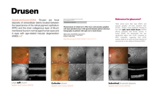 Drusen
Large soft drusen
Spaide and Curcio (2010)
Cuticular drusen
Spaide and Curcio (2010)
Subretinal drusenoid deposits
Spaide and Curcio (2010)
SpaideandCurcio (2010): “Drusen are focal
deposits of extracellular debris located between
the basal lamina of the retinal pigment epithelium
(RPE) and the inner collagenous layer of Bruch
membrane found in normal aged human eyes and
in eyes with age-related macular degeneration
(AMD).1–3“
Relevance forglaucoma?
“Both retinal nerve fiber layer (RNFL) and
macular ganglion cell–inner plexiform layer
(GCIPL) analysis reveal significant thinning in
eyes with optic nerve head drusen (ONHD)
directly correlated with drusen severity. In
buried ONHD, the abnormality rate was
significantly higher with GCIPL compared to
RNFL evaluation, suggesting that GCIPL
analysis might be an early structural indicator of
neuronal loss in the setting of thickened RNFL.”
http://dx.doi.org/10.1007/s00417-014-2773-5
 