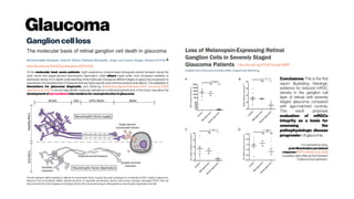 Glaucoma
Ganglioncellloss
http://dx.doi.org/10.1016/j.preteyeres.2011.11.002 http://dx.doi.org/10.1167/iovs.16-19997
Axonal transport failure leading to deficits in neurotrophic factor supply has been proposed to contribute to RGC death in glaucoma.
Neurons that successfully obtain optimal amounts of essential neurotrophic factors will survive, whereas damaged RGCs that are
disconnected fromtheirtargets and undergo obstructionof axonal transport will experience neurotrophic deprivationand die.
At the molecular level, some patients might experience compromised retrograde axonal transport along the
optic nerve and target-derived neurotrophin deprivation, while others might suffer from increased oxidative or
excitotoxic stress. An in-depth understanding of the molecular changesat differentstagesof glaucoma progression is
essential for the development of therapies that are highly specificand minimize adversesideeffects. Theavailability of
biomarkers for glaucoma diagnostic and follow-up (Golubnitschaja and Flammer, 2007; Grusetal., 2008;
Joachimetal.,2007a) should help identify molecular alterations in individual patients and, in the future, may allow the
developmentofpersonalized interventionsfor neuroprotection inglaucoma
Conclusions: This is the first
report illustrating histologic
evidence for reduced mRGC
density in the ganglion cell
layer of retinas with severely
staged glaucoma compared
with age-matched controls.
This result proposes
evaluation of mRGCs
integrity as a basis for
assessing the
pathophysiologic disease
progression of glaucoma.
For examplebyusing
post-illuminationpersistent
response(PIPR; Adhikarietal. 2016)
inpupillarylightreflex astheindication
of glaucoma progression.
 