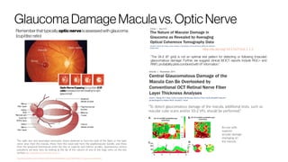 GlaucomaDamage Maculavs.OpticNerve
OpticNerveCupping [i.ecup/disk C/D
ratio increasesfromleft(healthy)to right
Rememberthattypically opticnerve isassessedwith glaucoma
(cup/discratio)
http://dx.doi.org/10.1167/tvst.1.1.3
“The 24-2 (6° grid) is not an optimal test pattern for detecting or following (macular)
glaucomatous damage. Further, we suggest clinical fdOCT reports include RGC+ and
RNFL probabilityplotscombinedwithVFinformation.”
“To detect glaucomatous damage of the macula, additional tests, such as
macular cube scans and/or 10-2 VFs, should be performed.”
An eye with
superior
arcuate damage
impinging on
the macula.The optic disc and associated structures. Axons destined to form the bulk of the fibers in the optic
nerve arise from the macula, those from the nasal side form the papillomacular bundle, and those
from the temporal hemimacula enter the disc as superior and inferior arcades. Spontaneous venous
pulsations are best seen by looking at the tip of the column of one of the large veins on the disc
surface.http://neupsykey.com/the-optic-nerve-2/
http://epomedicine.com/medical-students/understanding-visual-field-defects-in-glaucoma-perimetry/
 
