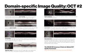 Domain-specificImageQuality:OCT#2
The left image is blurred due to poor focusing. This results in increased
noise and loss of transversal resolution in the OCT image on the right.
Signal: The signal strength for this image is 13 dB which is lower than the limit
of 15 dB. This results in a more noisy OCT image with a lot of speckling.
Decentration: The ring scan is not correctly centred as can be observed in
the left image. The edge of the optic nerve head crosses more than two
circles. Therefore the ringscan is rejected.
Algorithm failure: The red line in the OCT image right is not clearly at the
border of the RNFL. The location corresponds to inferior of the ONH.
Retinal pathology: There is severe peri-papillary atrophy. It can be seen that this
affects the RNFL enormously.
Illumination: The OCT scan here is badly illuminated. Also here
this results in speckling and decrease of resolution.
Beam placement: the laser beam is not placed centrally. This can be seen
at the outer nuclear layer (ONL). The two arrows point to two regions of
the ONL. The left arrow points to a light gray region whereas the other
points to a darker gray region. If there is too much difference in colour of
the ONL itself a scan is rejected.
The OSCAR-IB Consensus Criteria for Retinal OCT
Quality Assessment
http://dx.doi.org/10.1371/journal.pone.0034823
 
