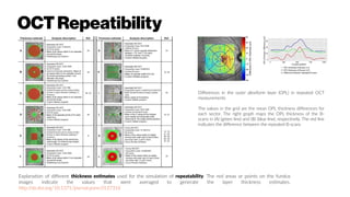 OCTRepeatibility
Explanation of different thickness estimates used for the simulation of repeatability. The red areas or points on the fundus
images indicate the values that were averaged to generate the layer thickness estimates.
http://dx.doi.org/10.1371/journal.pone.0137316
Differences in the outer plexiform layer (OPL) in repeated OCT
measurements
The values in the grid are the mean OPL thickness differences for
each sector. The right graph maps the OPL thickness of the B-
scans in (A) (green line) and (B) (blue line), respectively. The red line
indicates the difference between the repeated B-scans
 