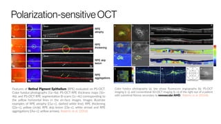 Polarization-sensitiveOCT
Features of Retinal Pigment Epithelium (RPE) evaluated on PS-OCT.
Color fundus photographs (1a–4a); PS-OCT RPE thickness maps (1b–
4b); and PS-OCT RPE segmentation B-scans (1c–4c) corresponding to
the yellow horizontal lines in the en-face images. Images illustrate
examples of RPE atrophy ([1a–c], dashed white line); RPE thickening
([2a–c], yellow circle); RPE skip lesion ([3a–c], white arrow) and RPE
aggregations ([4a–c]: yellow arrows). Roberts et al. (2016)
Color fundus photography (a), late phase fluorescein angiography (b), PS-OCT
imaging (c–j), and conventional SD-OCT imaging (k–o) of the right eye of a patient
with subretinal fibrosis secondary to neovascular AMD. Roberts et al. (2016)b
 