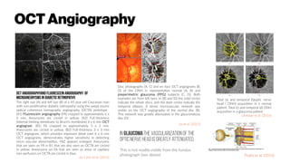 OCTAngiography
OCT Angiographyand Fluorescein Angiography of
Microaneurysmsin diabetic retinopathy.
The right eye (A) and left eye (B) of a 45 year old Caucasian man
with non-proliferative diabetic retinopathy using the swept source
optical coherence tomography angiography (OCTA) prototype
(A1) Fluorescein angiography (FA) cropped to approximately 6 x
6 mm. Aneurysms are circled in yellow. (A2) Full-thickness
(internal limiting membrane to Bruch’s membrane) 6 x 6 mm OCT
angiogram. (B1) FA cropped to approximately 3 x 3 mm.
Aneurysms are circled in yellow. (B2) Full-thickness 3 x 3 mm
OCT angiogram, which provides improved detail over 6 x 6 mm
OCT angiograms, demonstrates higher sensitivity in detecting
micro vascular abnormalities. FAZ appears enlarged. Aneurysms
that are seen on FA in B1 that are also seen on OCTA are circled
in yellow. Aneurysms on FA that are seen as areas of capillary
non-perfusion on OCTA are circled in blue.
de Carlo et al. (2015)
Disc photographs (A, C) and en face OCT angiograms (B,
D) of the ONH in representative normal (A, B) and
preperimetric glaucoma (PPG) subjects (C, D). Both
examples are from left eyes. In (B) and (D) the solid circles
indicate the whole discs, and the dash circles indicate the
temporal ellipses. A dense microvascular network was
visible on the OCT angiography of the normal disc (B).
This network was greatly attenuated in the glaucomatous
disc (D)
Jia et al. (2012)
Total (a) and temporal (b)optic nerve
head ( ONH) acquisition in a normal
patient. Total (c) and temporal (d) ONH
acquisition in a glaucoma patient
Lévêque et al. (2016)
In glaucoma the vascularization of the
optic nerve head is greatly attenuated,
This is not readily visible from the fundus
photograph (see above) Prada et al. (2016)
 