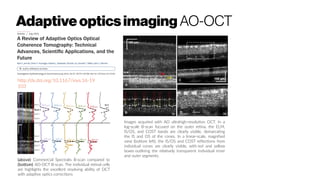 Adaptive opticsimaging AO-OCT
(above) Commercial Spectralis B-scan compared to
(bottom) AO-OCT B-scan. The individual retinal cells
are highlights the excellent resolving ability of OCT
with adaptive optics corrections
Images acquired with AO ultrahigh-resolution OCT. In a
log-scale B-scan focused on the outer retina, the ELM,
IS/OS, and COST bands are clearly visible, demarcating
the IS and OS of the cones. In a linear-scale, magnified
view (bottom left), the IS/OS and COST reflections from
individual cones are clearly visible, with red and yellow
boxes outlining the relatively transparent individual inner
and outer segments.
http://dx.doi.org/10.1167/iovs.16-19
103
 