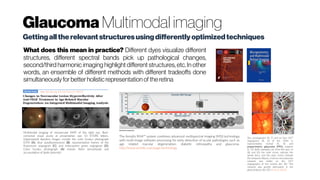 Glaucoma Multimodal imaging
Multimodal imaging of neovascular AMD of the right eye. Best-
corrected visual acuity at presentation was 53 ETDRS letters.
(Upperpanel) Baseline images include the color fundus photograph
(CFP) (A), blue autofluorescence (B), representative frames of the
fluorescein angiogram (C), and indocyanine green angiogram (D).
Color fundus photograph (A) reveals fibrin (arrowhead) and
accumulation of lipids (asterisk).
http://dx.doi.org/10.1167/iovs.15-18753
Gettingalltherelevant structuresusingdifferentlyoptimizedtechniques
What does this mean in practice? Different dyes visualize different
structures, different spectral bands pick up pathological changes,
second/third harmonic imaging highlight different structures, etc. In other
words, an ensemble of different methods with different tradeoffs done
simultaneouslyfor better holisticrepresentation oftheretina
The Annidis RHA™ system combines advanced multispectral imaging (MSI) technology
with multi-image software processing for early detection of ocular pathologies such as
age related macular degeneration, diabetic retinopathy and glaucoma.
http://www.annidis.com/page/technology
Disc photographs (A, C) and en face OCT
angiograms (B, D) of the ONH in
representative normal (A, B) and
preperimetric glaucoma (PPG) subjects
(C, D). Both examples are from left eyes. In
(B) and (D) the solid circles indicate the
whole discs, and the dash circles indicate
the temporal ellipses. A dense microvascular
network was visible on the OCT
angiography of the normal disc (B). This
network was greatly attenuated in the
glaucomatous disc (D) Jia et al. (2012)
 