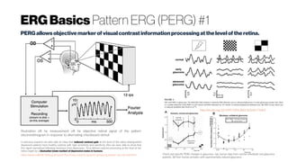 ERGBasics Pattern ERG (PERG) #1
PERG allowsobjective marker of visual contrastinformation processingatthe levelof the retina.
lllustration oft he measurement oft he objective retinal signal of the pattern
electroretinogram in response to alternating checkboard stimuli
In precious research we were able to show that reduced contrast gain at the level of the retina distinguished
depressed patients form healthy controls with high sensitivity and specificity. Also we were able to show that
this signal normalized following remission from depression. Thus altered contrast processing at the level of the
retina might be a biomarker (state marker) of depressive states in humans.
https://www.uniklinik-freiburg.de/psych/forschung-research/research-groups/rg-tebartz-van-elst-bubl.html
 